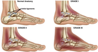 severity of ankle sprain
