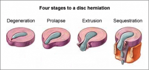 4 Stages To Disc Herniation