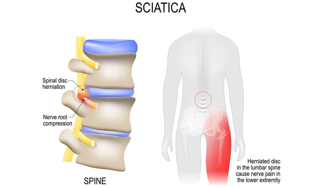 illustration of sciatica herniated disc